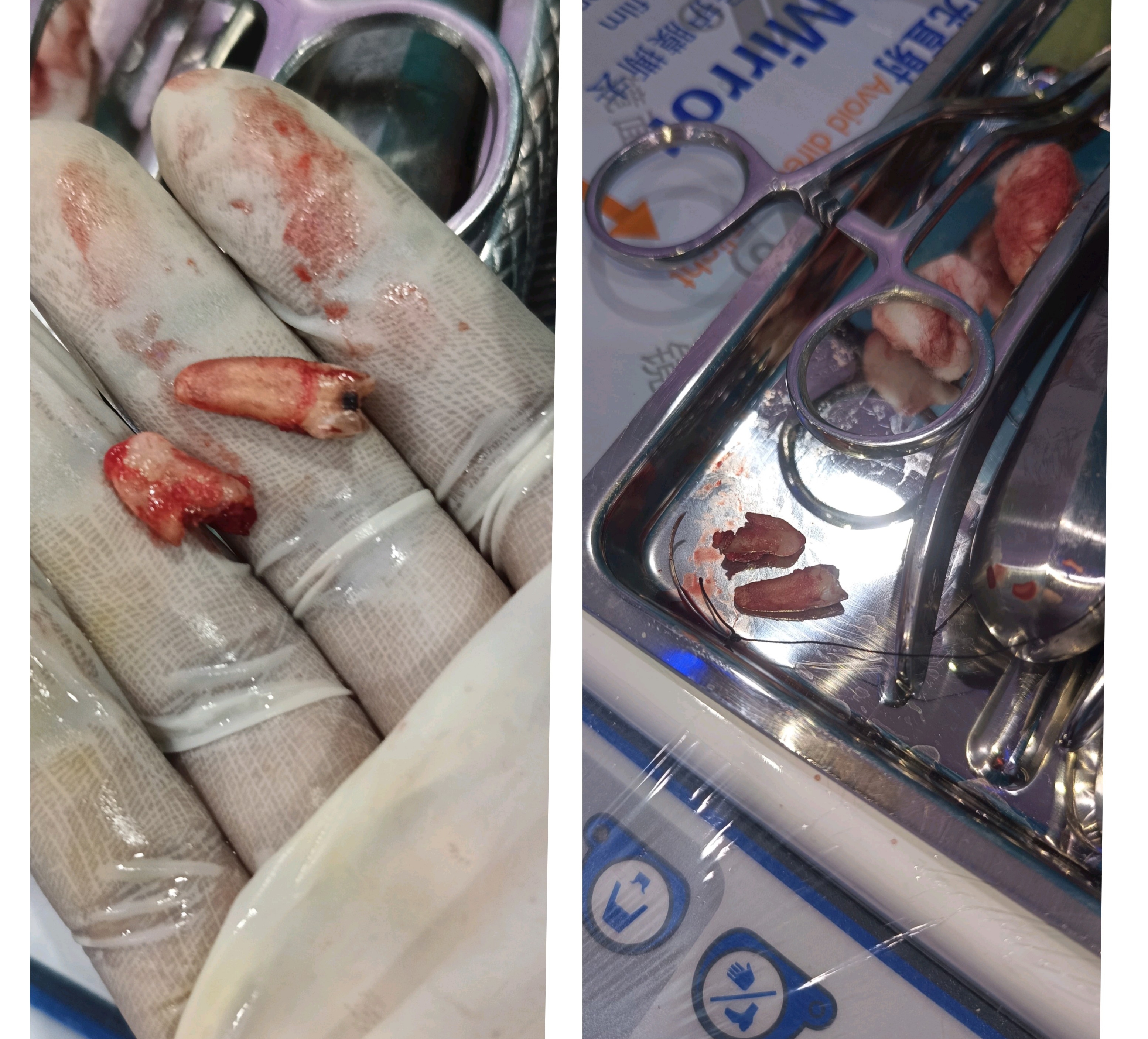Painless Tooth Extraction under LOCAL ANAESTHESIA 