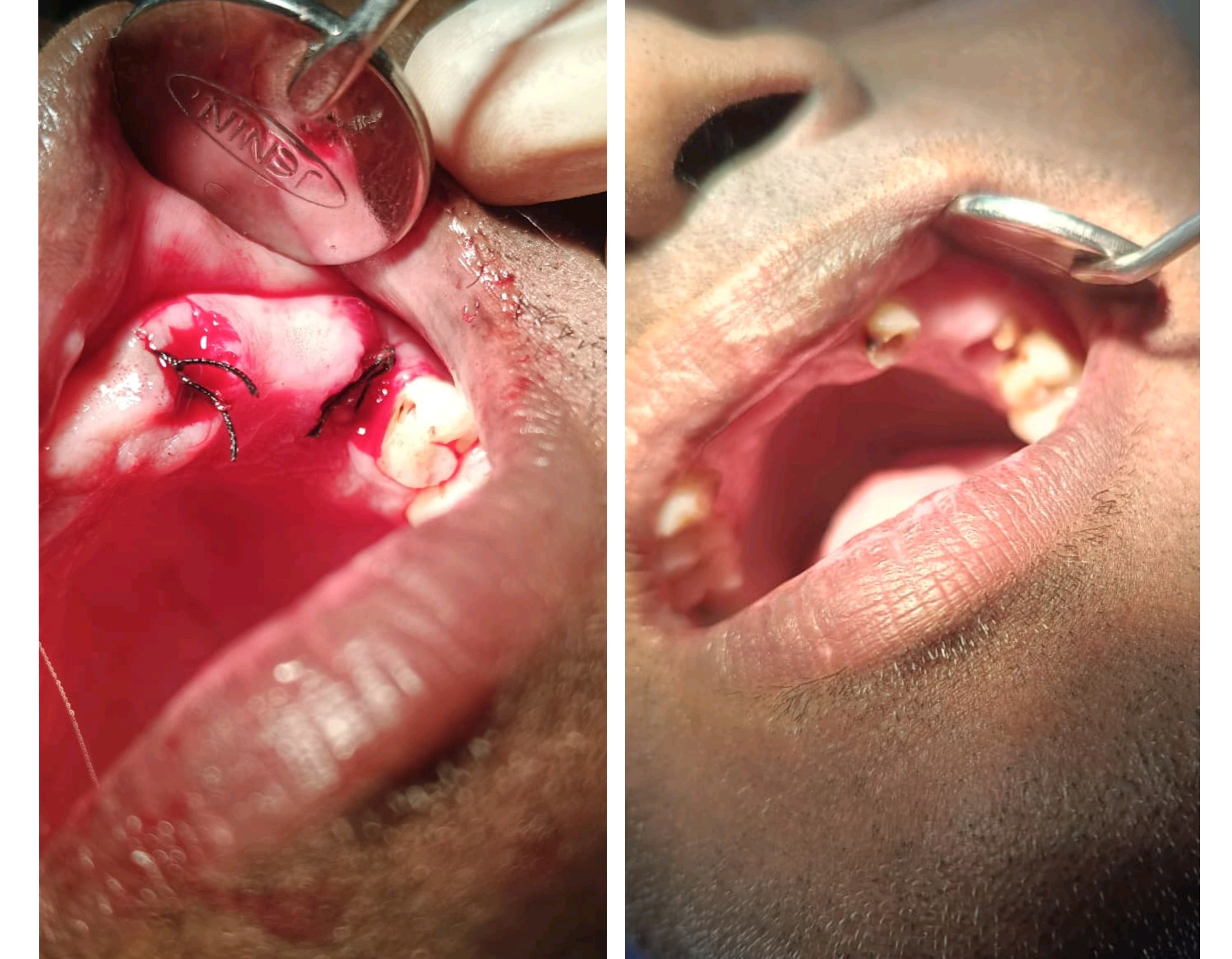PAINLESS EXTRACTION  dental clinic gallery photo