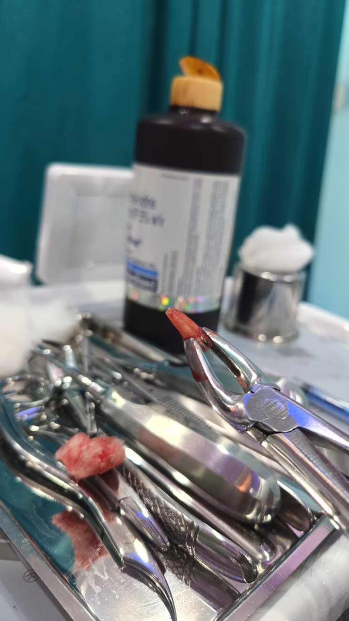 PAINLESS EXTRACTION  dental clinic gallery photo
