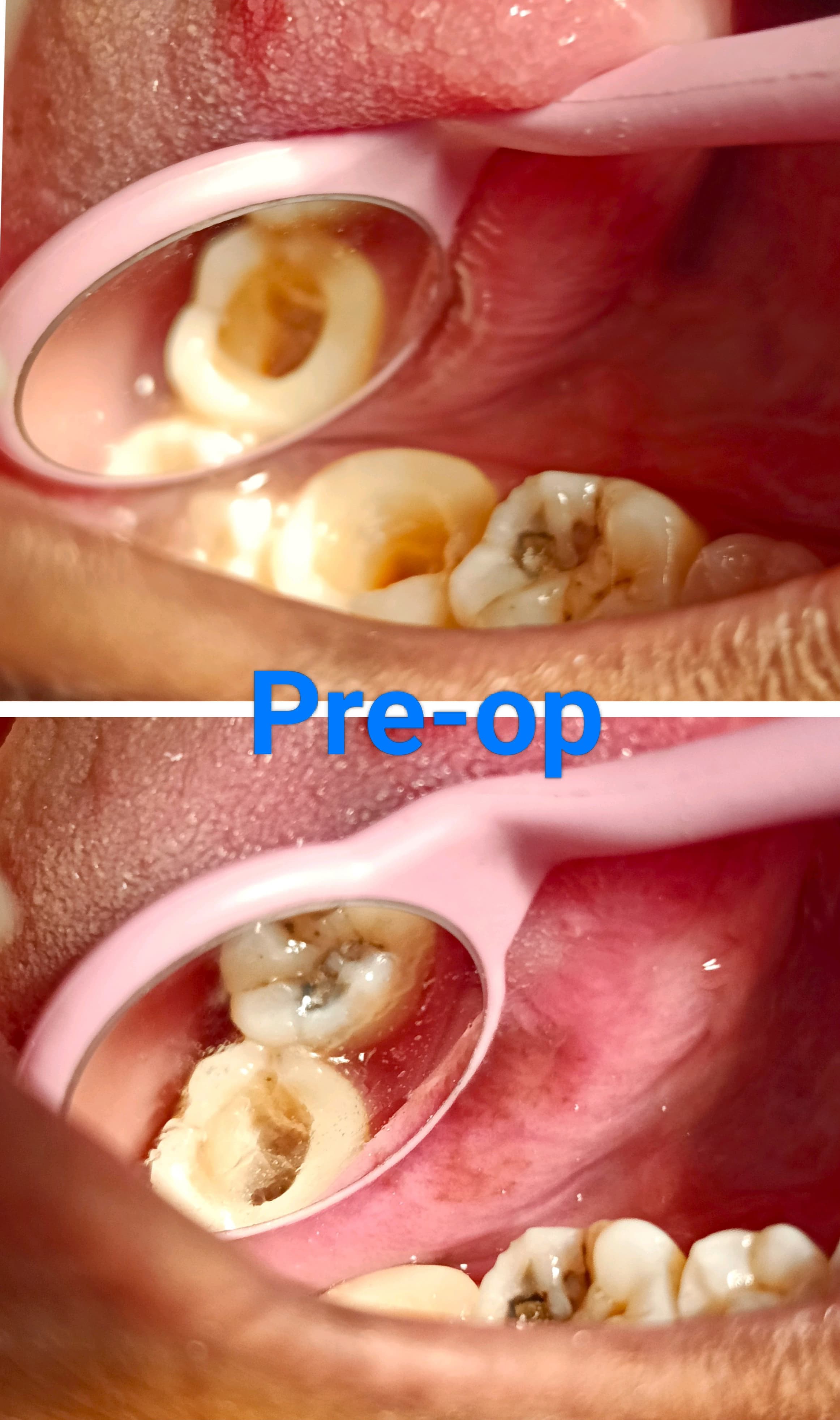 Functional Tooth Restoration After RCT