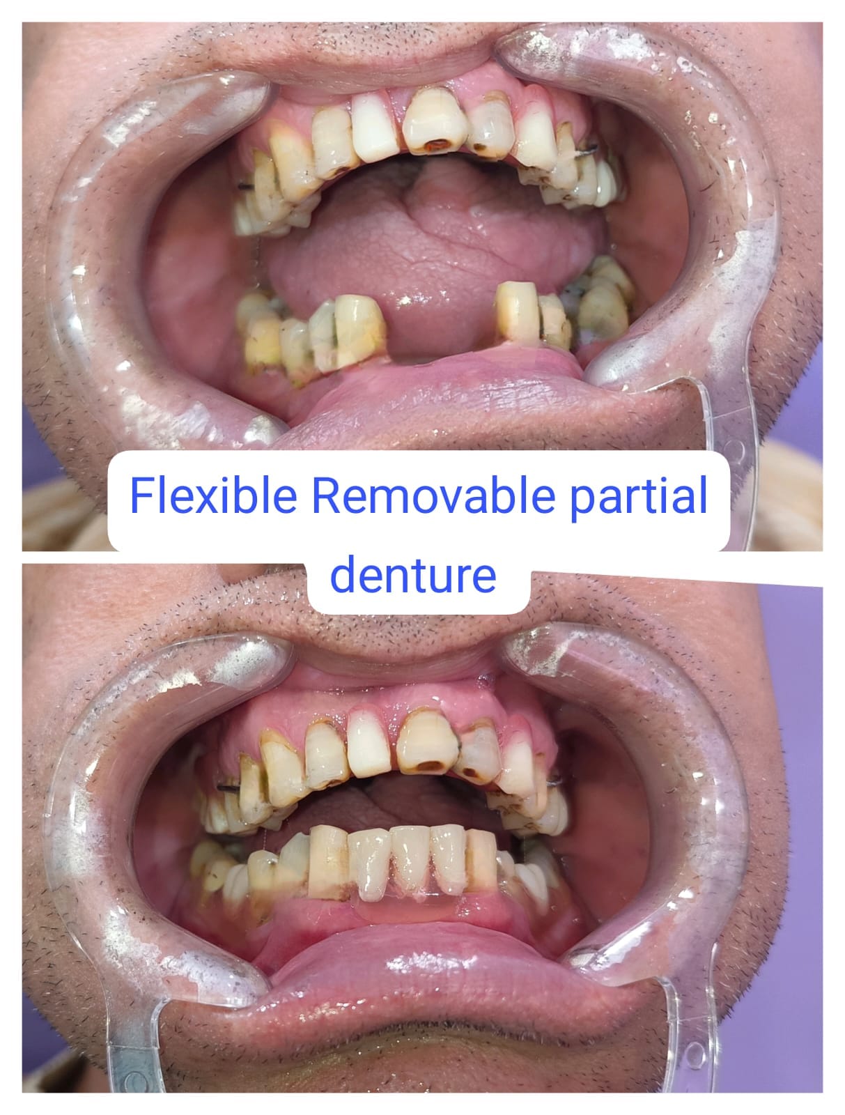 নকল দাঁত বাঁধানো (CD, RPD, FPD) service at Orchid Dental Clinic