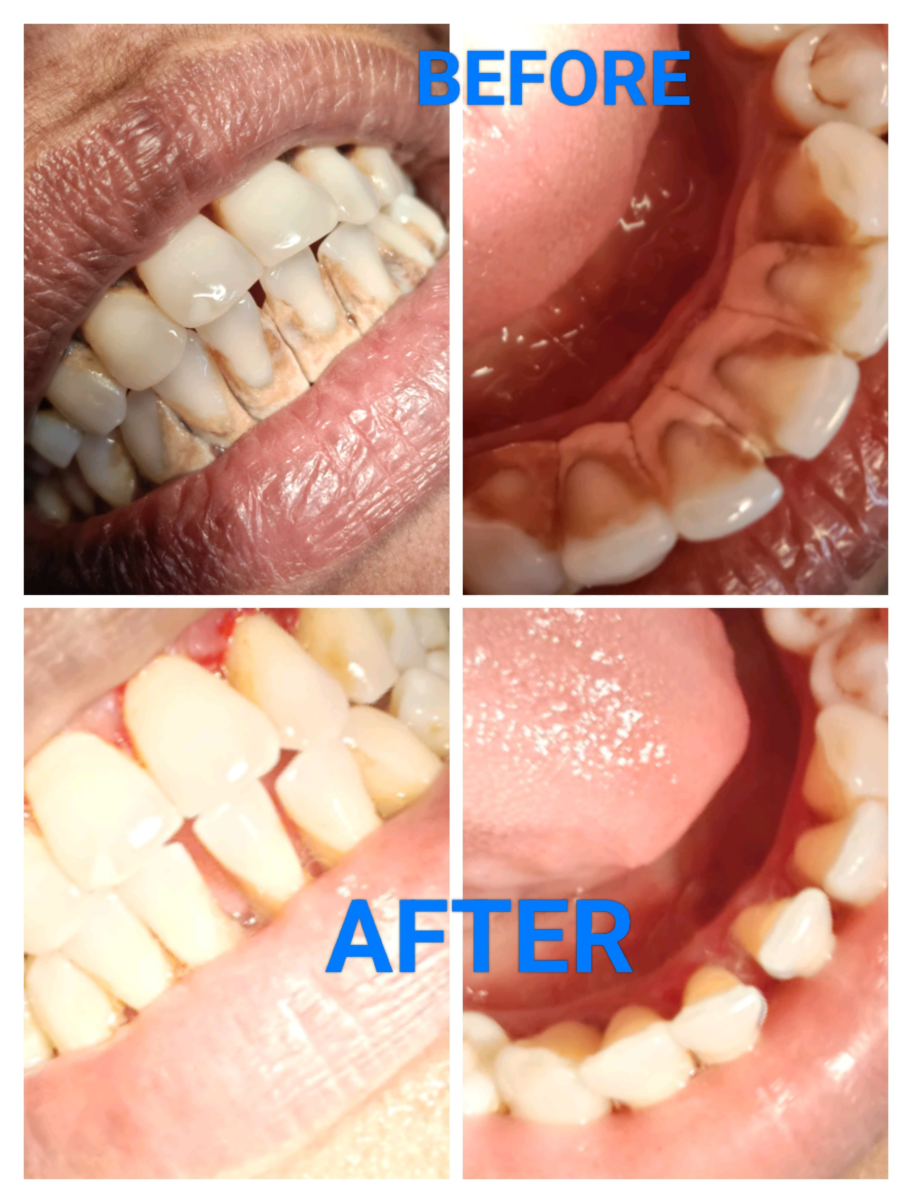 Ultrasonic Scaling and Prophylaxis Fluoride Paste Polishing.